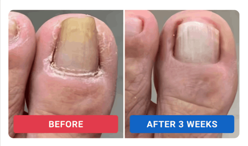 Orivello Nail Fungus Pen review by Dan R. – Orivello